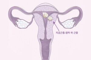 난임 유발하는 ‘자궁근종∙자궁선근증∙자궁내막증’과 생리의 관계는?