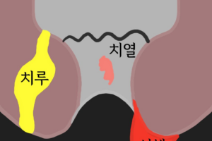 항문통증, 항문출혈, 항문종기 원인 + 극복법 정리!